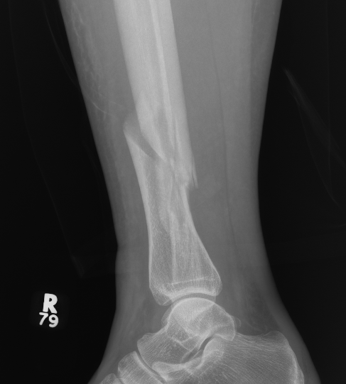 Distal tibia 2